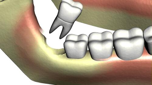 Что делать при переломе зуба — методы лечения и реставрации